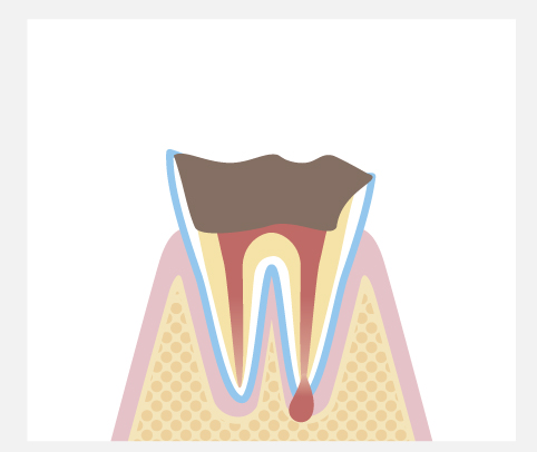 C4：歯質が失われた虫歯